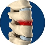 bone-on-bone-vertebrae__PID:cc825ab1-41a6-44a0-b46d-3c90f6fa4107